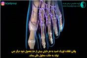 بیماری نقرس و درمان آن