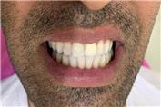 هوم بلیچینگ چیست
