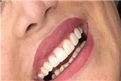 زیبایی طرح لبخند