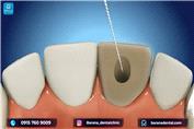 دندان های جلو را چگونه عصب کشی می کنند؟