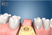 مراحل کلی کاشت ایمپلنت دندان و قرار دادن روکش روی آن | دکتر محمد محمدی