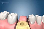 مراحل انجام ایمپلنت دندان چگونه است؟