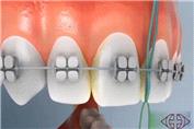 روش صحیح کشیدن نخ دندان ارتودنسی