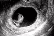سونوگرافی از هفته 5 تا 38 بارداری