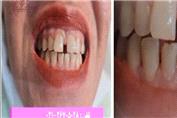 کامپوزیت ونیر و بستن فاصله دندانی(دیاستم)