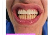8 واحد کامپوزیت همراه با بستن فاصله بین دندانی برای زیباجوی ما